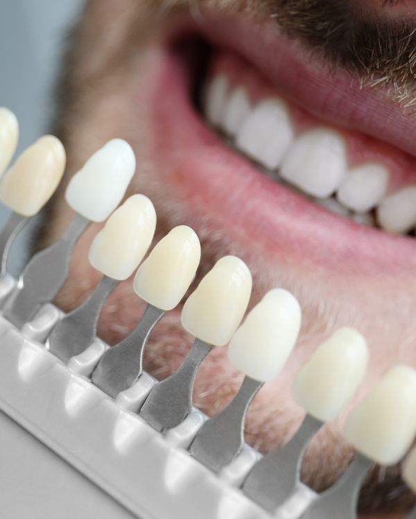 Cosmetic Bonding