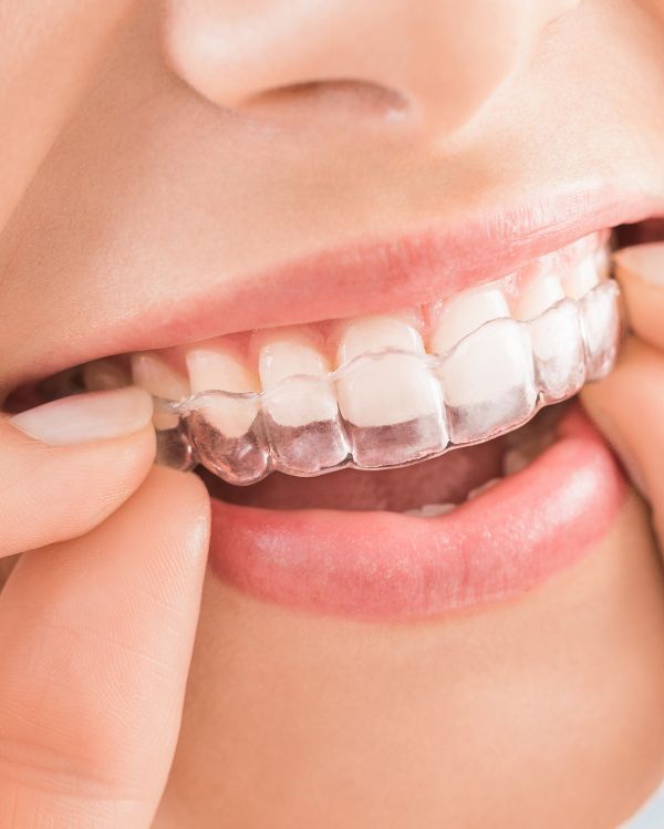 Invisalign® & Clear Aligners
