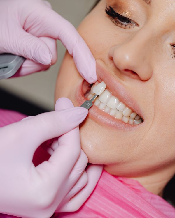 Porcelain Veneers