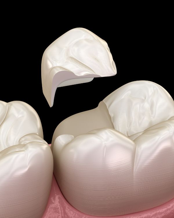 Tooth-Coloured Fillings