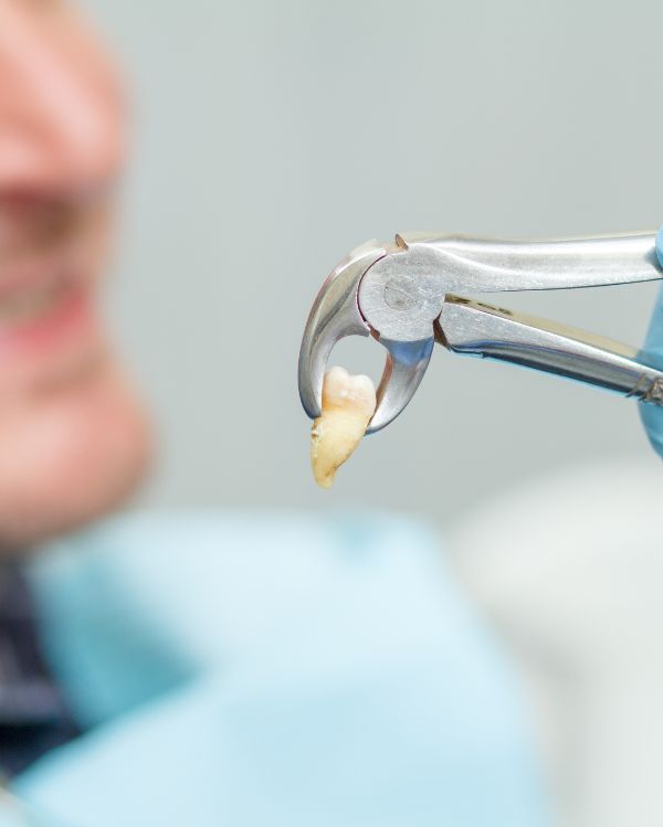 Tooth Extractions & Wisdom Teeth